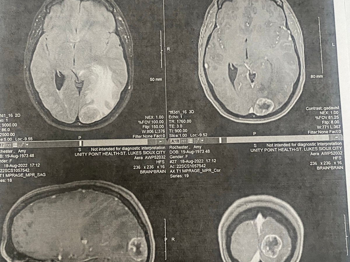 Chemo and Radiation- Real Faith vs.&nbsp;Denial.